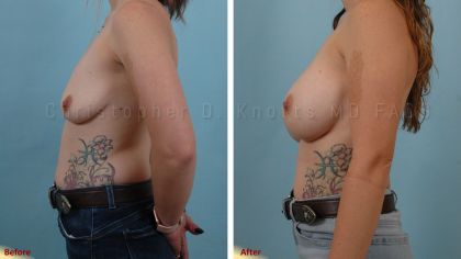 Plastic Surgery Institute of New Mexico breast augmentation result — Albuquerque, NM
