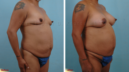Plastic Surgery Institute of New Mexico breast augmentation result — Albuquerque, NM
