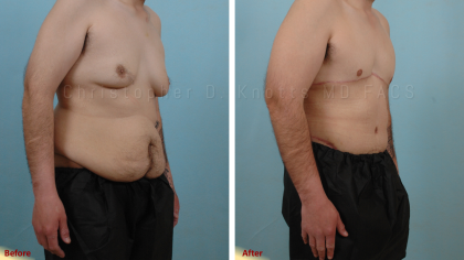 Gynecomastia Surgery result at Plastic Surgery Institute of New Mexico in Albuquerque, NM