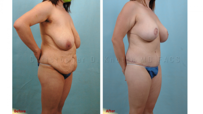 Mommy Makeover result at Plastic Surgery Institute of New Mexico in Albuquerque, NM