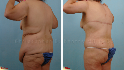 CoolSculpting result at Plastic Surgery Institute of New Mexico in Albuquerque, NM