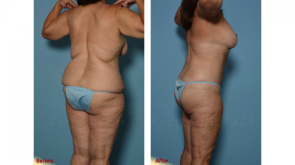 CoolSculpting result at Plastic Surgery Institute of New Mexico in Albuquerque, NM