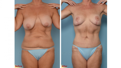 Mommy Makeover result at Plastic Surgery Institute of New Mexico in Albuquerque, NM