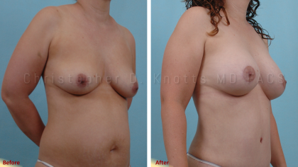 Breast Reduction result at Plastic Surgery Institute of New Mexico in Albuquerque, NM