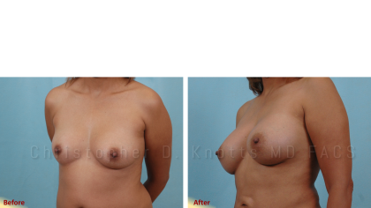 Plastic Surgery Institute of New Mexico breast augmentation result — Albuquerque, NM