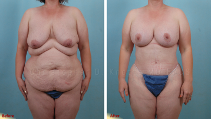 Mommy Makeover result at Plastic Surgery Institute of New Mexico in Albuquerque, NM