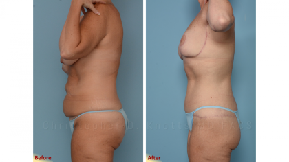 Mommy Makeover result at Plastic Surgery Institute of New Mexico in Albuquerque, NM