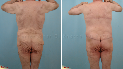 CoolSculpting result at Plastic Surgery Institute of New Mexico in Albuquerque, NM