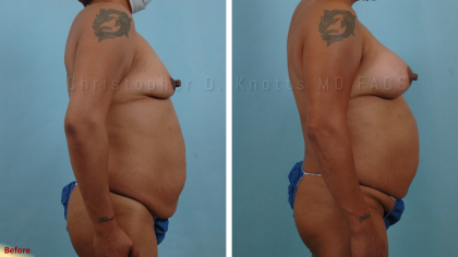 Plastic Surgery Institute of New Mexico breast augmentation result — Albuquerque, NM
