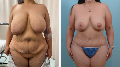 Breast Reduction result at Plastic Surgery Institute of New Mexico in Albuquerque, NM