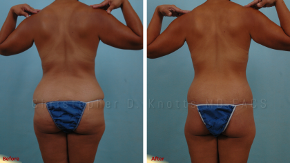 Brazilian Butt Lift result at Plastic Surgery Institute of New Mexico in Albuquerque, NM