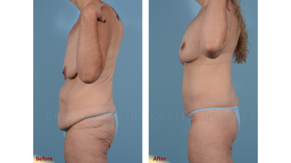 Mini Tummy Tuck result at Plastic Surgery Institute of New Mexico in Albuquerque, NM