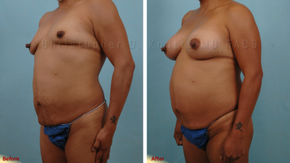 Plastic Surgery Institute of New Mexico breast augmentation result — Albuquerque, NM