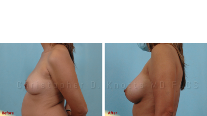 Plastic Surgery Institute of New Mexico breast augmentation result — Albuquerque, NM