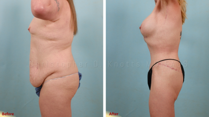 Mommy Makeover result at Plastic Surgery Institute of New Mexico in Albuquerque, NM