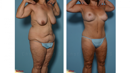 Mini Tummy Tuck result at Plastic Surgery Institute of New Mexico in Albuquerque, NM