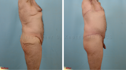CoolSculpting result at Plastic Surgery Institute of New Mexico in Albuquerque, NM
