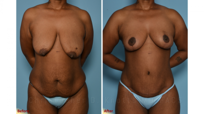 Mommy Makeover result at Plastic Surgery Institute of New Mexico in Albuquerque, NM