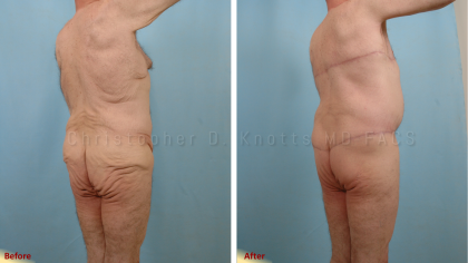 CoolSculpting result at Plastic Surgery Institute of New Mexico in Albuquerque, NM