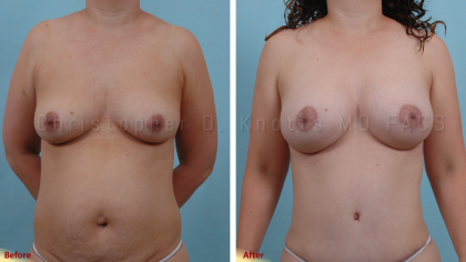 Breast Reduction result at Plastic Surgery Institute of New Mexico in Albuquerque, NM