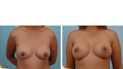 Plastic Surgery Institute of New Mexico breast augmentation result — Albuquerque, NM