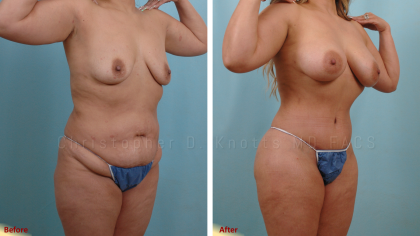 Mommy Makeover result at Plastic Surgery Institute of New Mexico in Albuquerque, NM