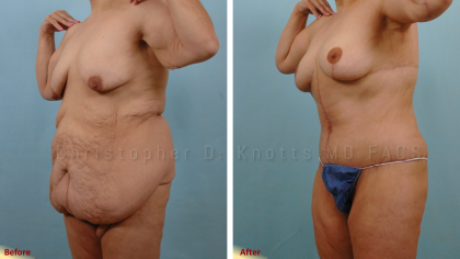 Mommy Makeover result at Plastic Surgery Institute of New Mexico in Albuquerque, NM