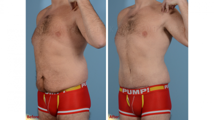 Brazilian Butt Lift result at Plastic Surgery Institute of New Mexico in Albuquerque, NM