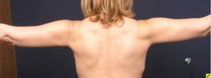 Marisa Lawrence Plastic Surgery & Med Spa arm lift after — Atlanta, GA