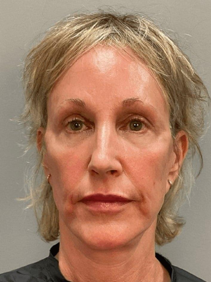 Marisa Lawrence Plastic Surgery & Med Spa facelift after — Atlanta, GA