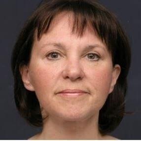 Marisa Lawrence Plastic Surgery & Med Spa facelift after — Atlanta, GA