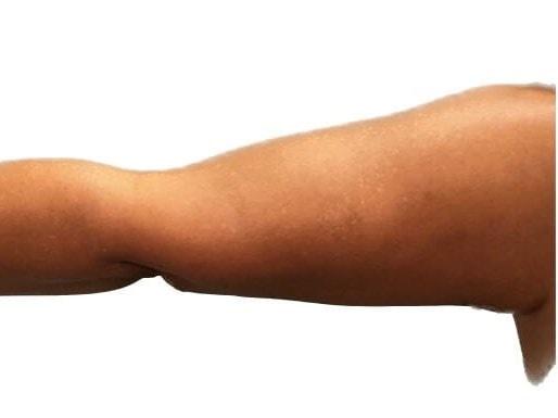 Marisa Lawrence Plastic Surgery & Med Spa arm lift after — Atlanta, GA