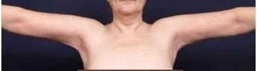Marisa Lawrence Plastic Surgery & Med Spa arm lift after — Atlanta, GA