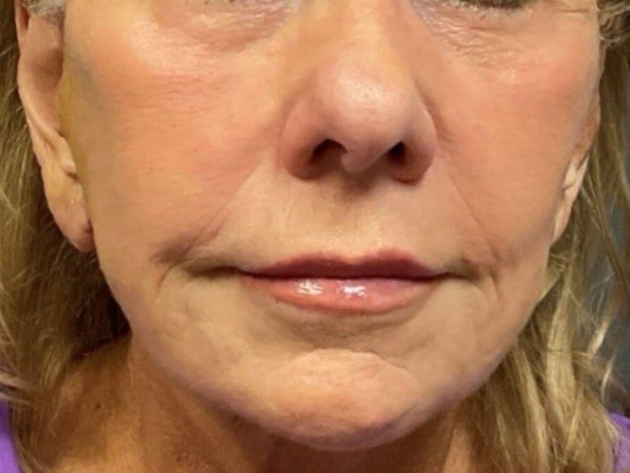 Marisa Lawrence Plastic Surgery & Med Spa facelift after — Atlanta, GA