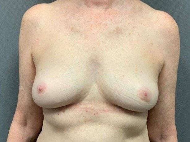 Marisa Lawrence Plastic Surgery & Med Spa breast implant removal after — Atlanta, GA