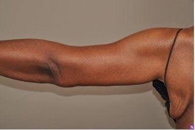 Marisa Lawrence Plastic Surgery & Med Spa arm lift after — Atlanta, GA