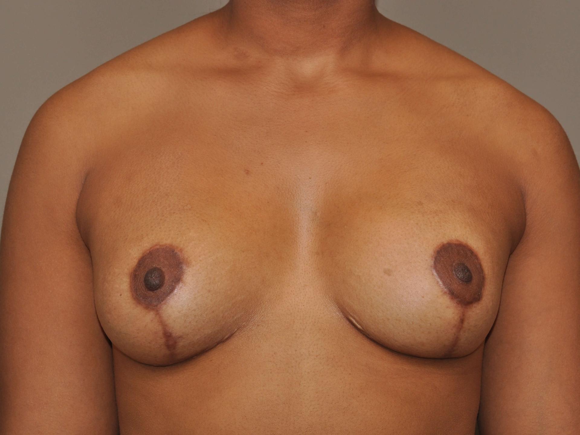 Marisa Lawrence Plastic Surgery & Med Spa breast lift after — Atlanta, GA
