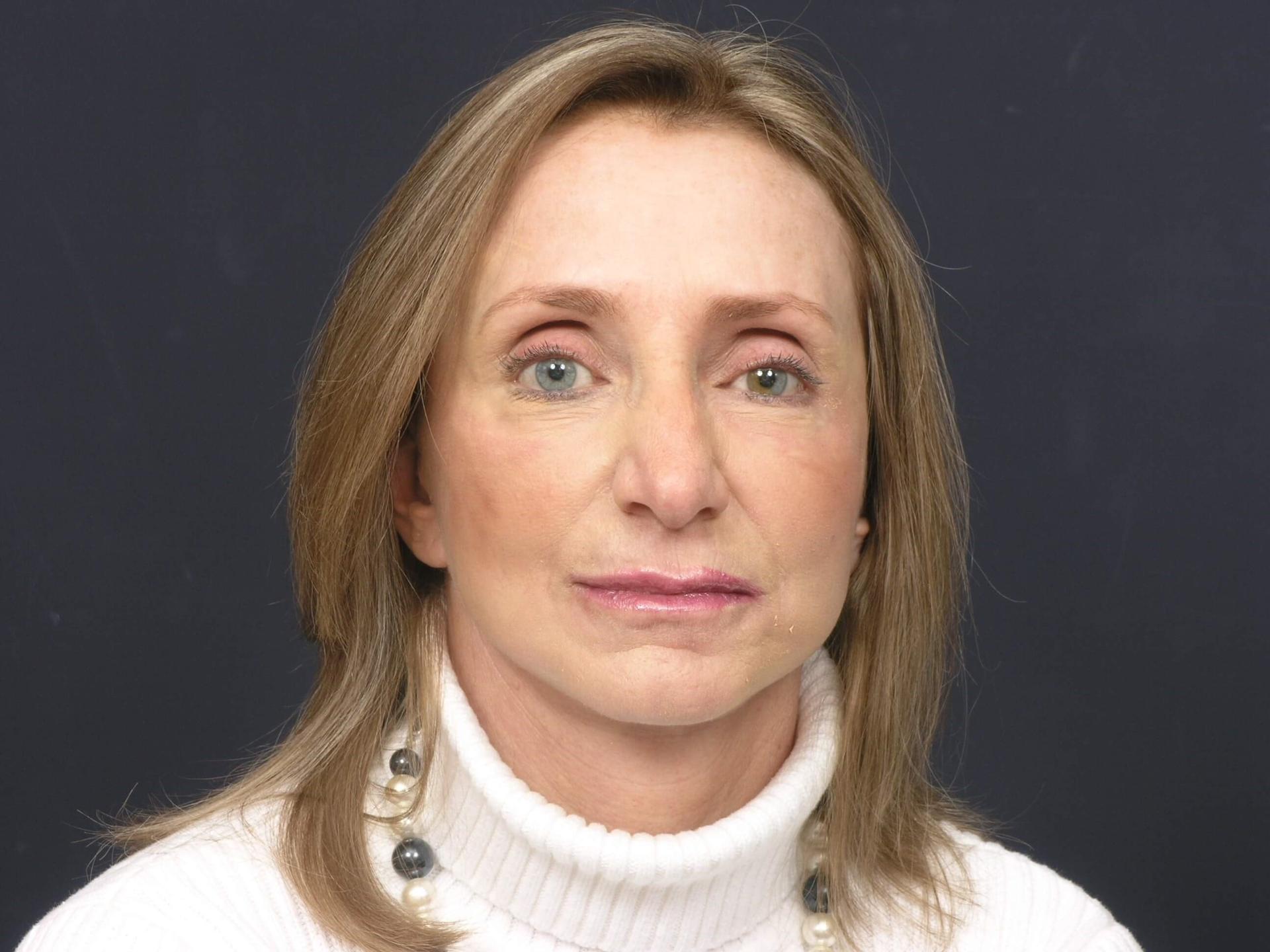 Marisa Lawrence Plastic Surgery & Med Spa facelift after — Atlanta, GA