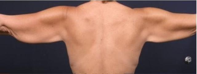 Arm Lift before at Marisa Lawrence Plastic Surgery & Med Spa in Atlanta, GA