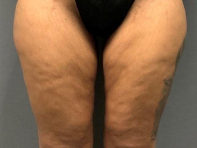 Thigh Lift before at Marisa Lawrence Plastic Surgery & Med Spa in Atlanta, GA