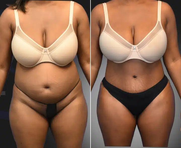 Aydin Center for Plastic Surgery tummy tuck result — Paramus, NJ