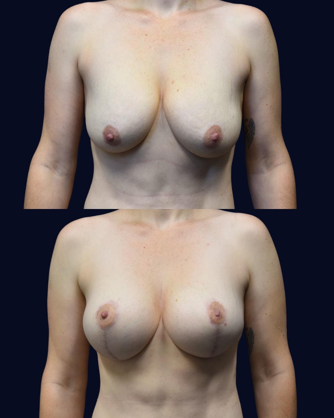 Aydin Center for Plastic Surgery mommy makeover result — Paramus, NJ