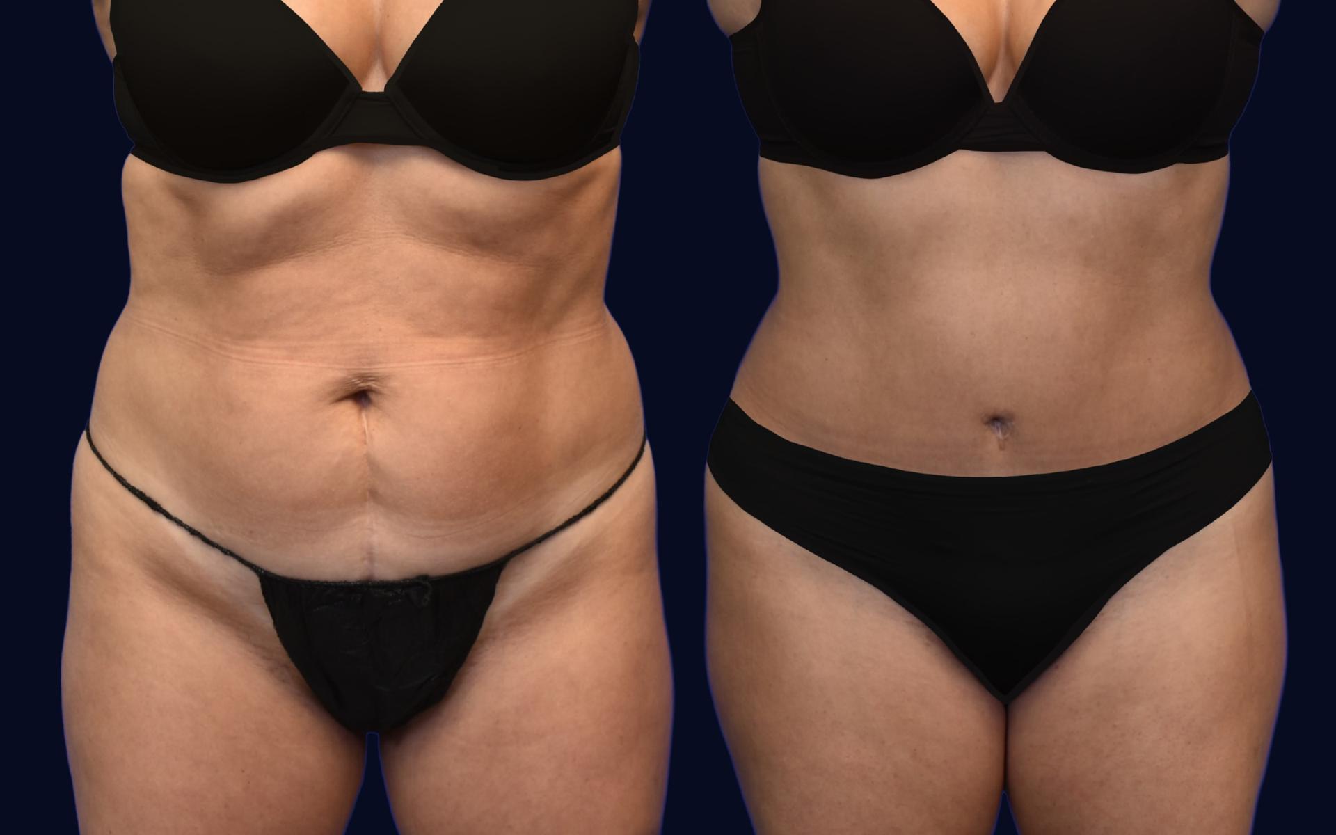 Aydin Center for Plastic Surgery tummy tuck result — Paramus, NJ