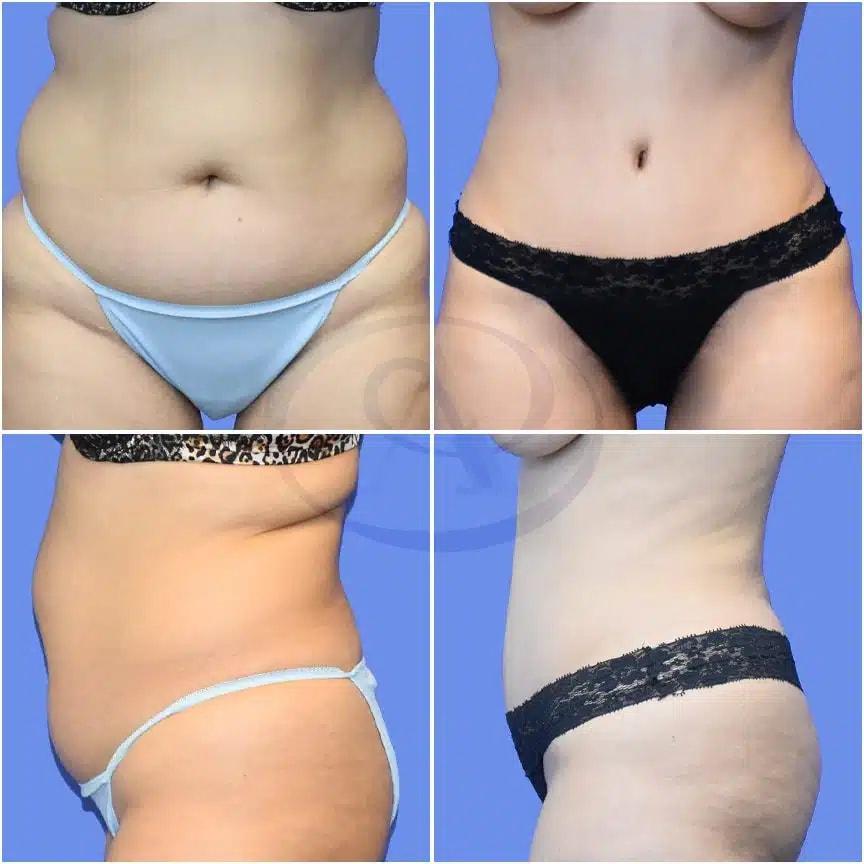 Aydin Center for Plastic Surgery tummy tuck result — Paramus, NJ