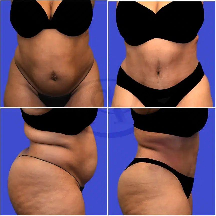 Aydin Center for Plastic Surgery tummy tuck result — Paramus, NJ