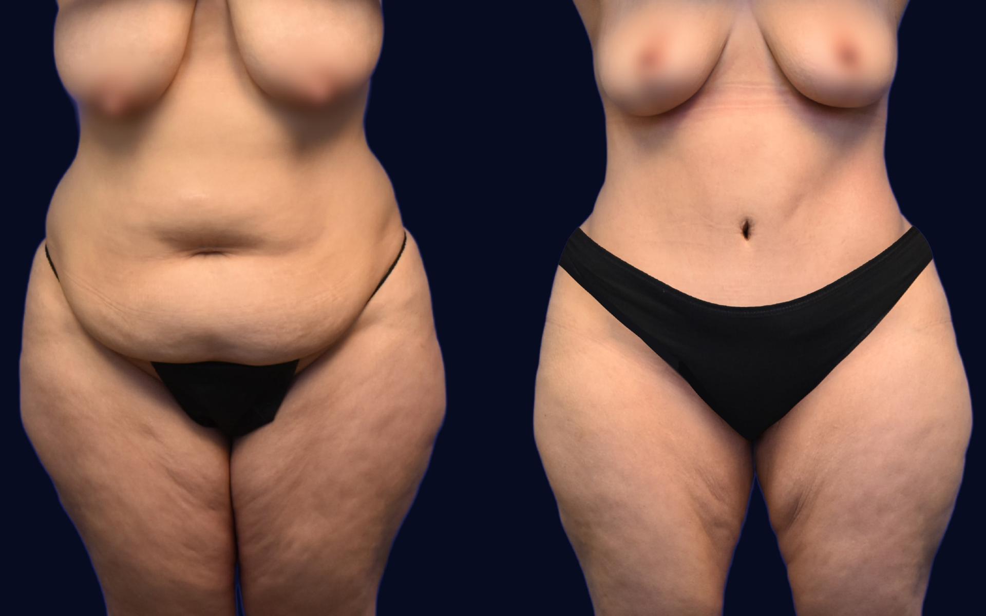 Aydin Center for Plastic Surgery tummy tuck result — Paramus, NJ