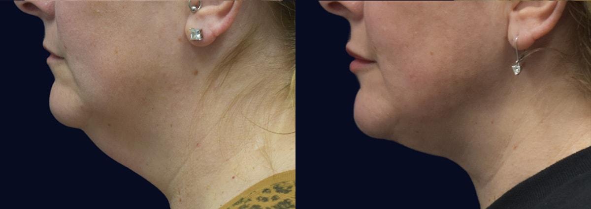 Aydin Center for Plastic Surgery neck lift result — Paramus, NJ
