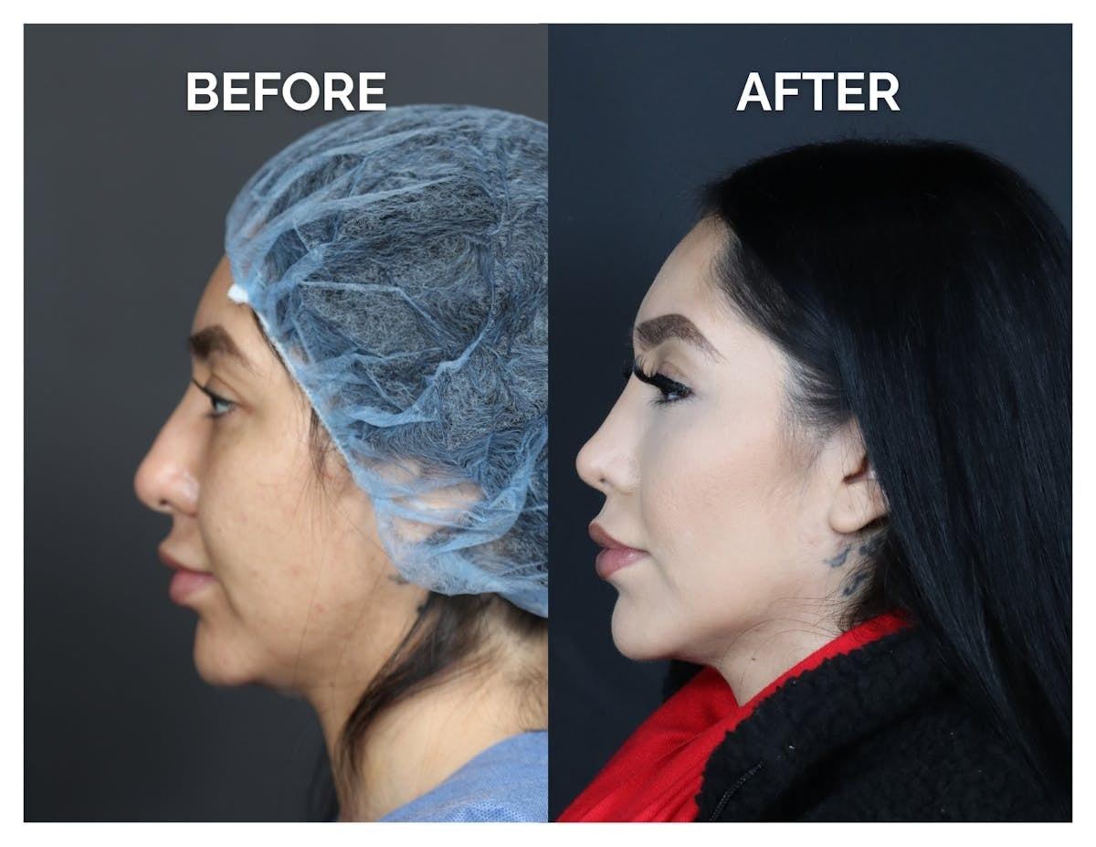 Anil Shah, MD, FACS Facial Plastics rhinoplasty result — Chicago, IL
