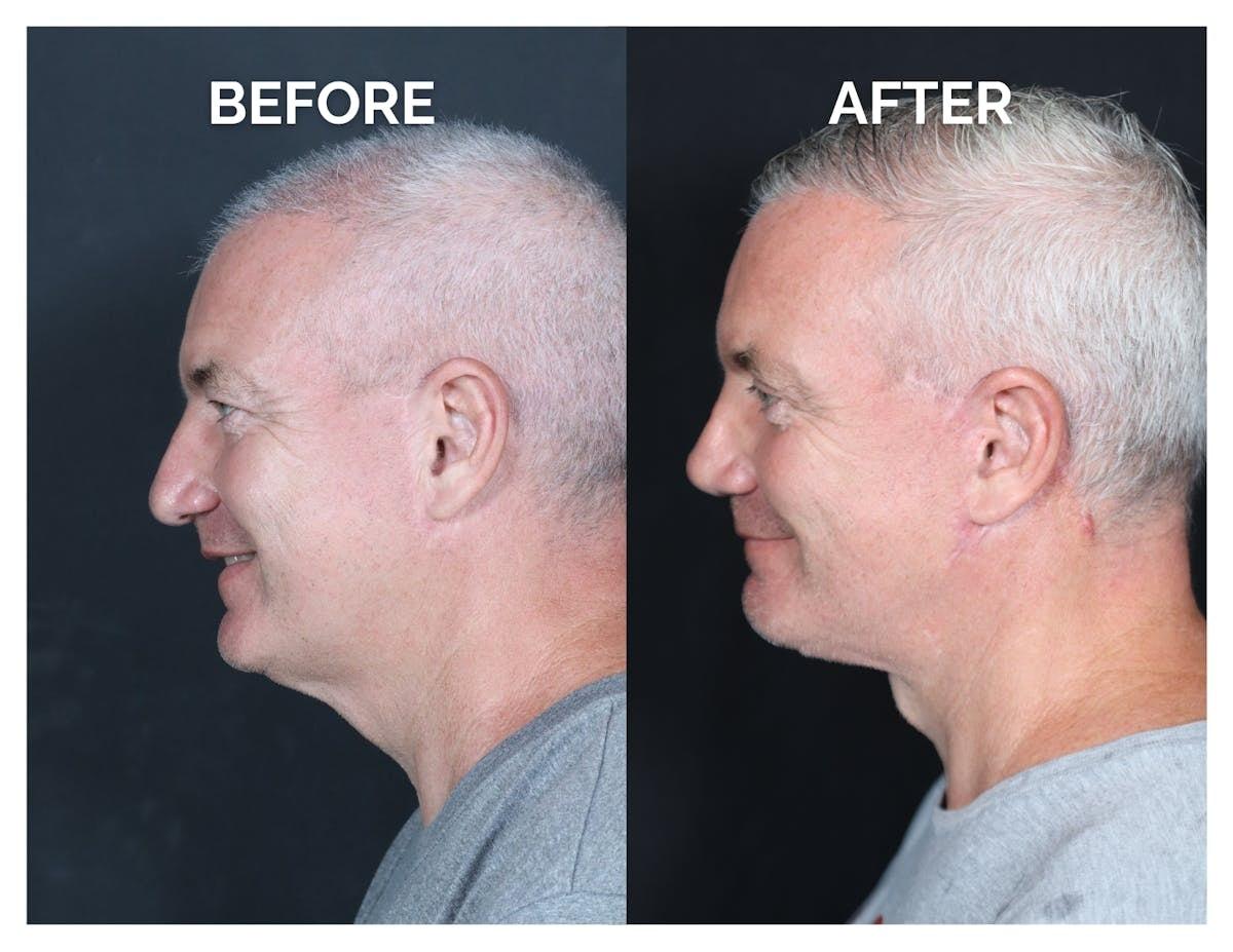 Anil Shah, MD, FACS Facial Plastics rhinoplasty result — Chicago, IL