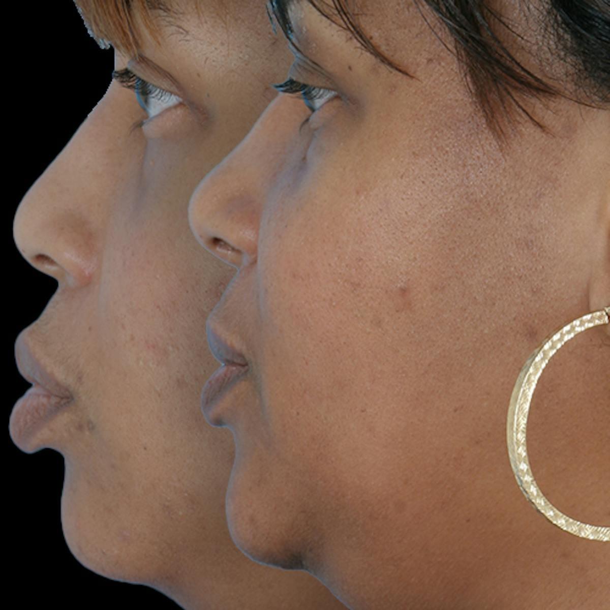 Anil Shah, MD, FACS Facial Plastics rhinoplasty result — Chicago, IL